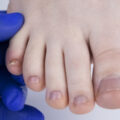 【ネイリスト解説】足の小指の爪が小さいのは治る？ケアとネイルの楽しみ方