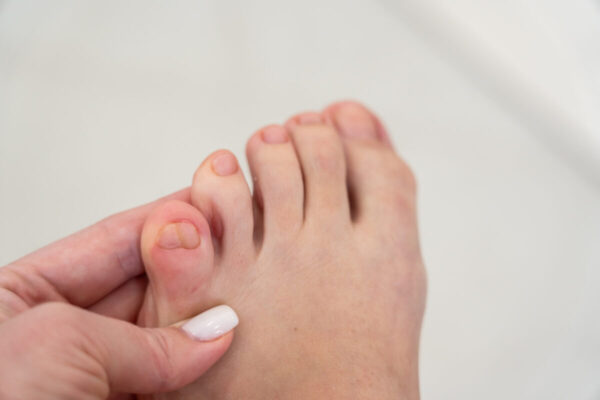 【ネイリスト解説】足の小指の爪が小さいのは治る？ケアとネイルの楽しみ方
